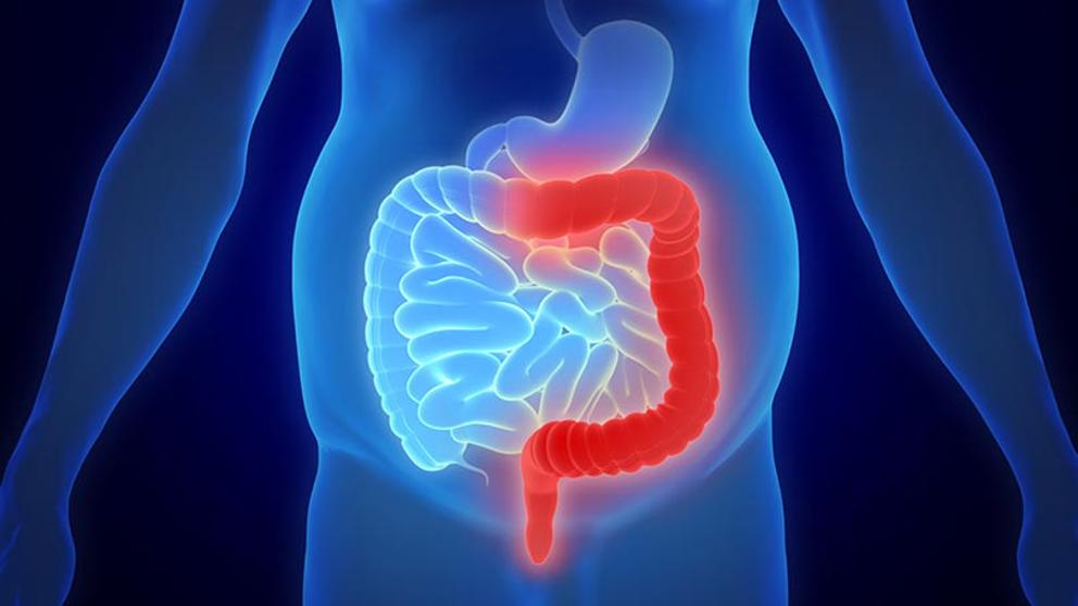 COLON IRRITABLE